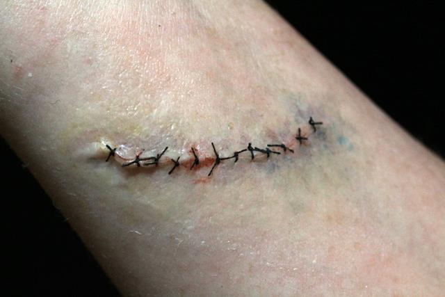Photo Blank as sutures_640x427