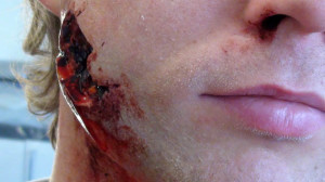 casualty